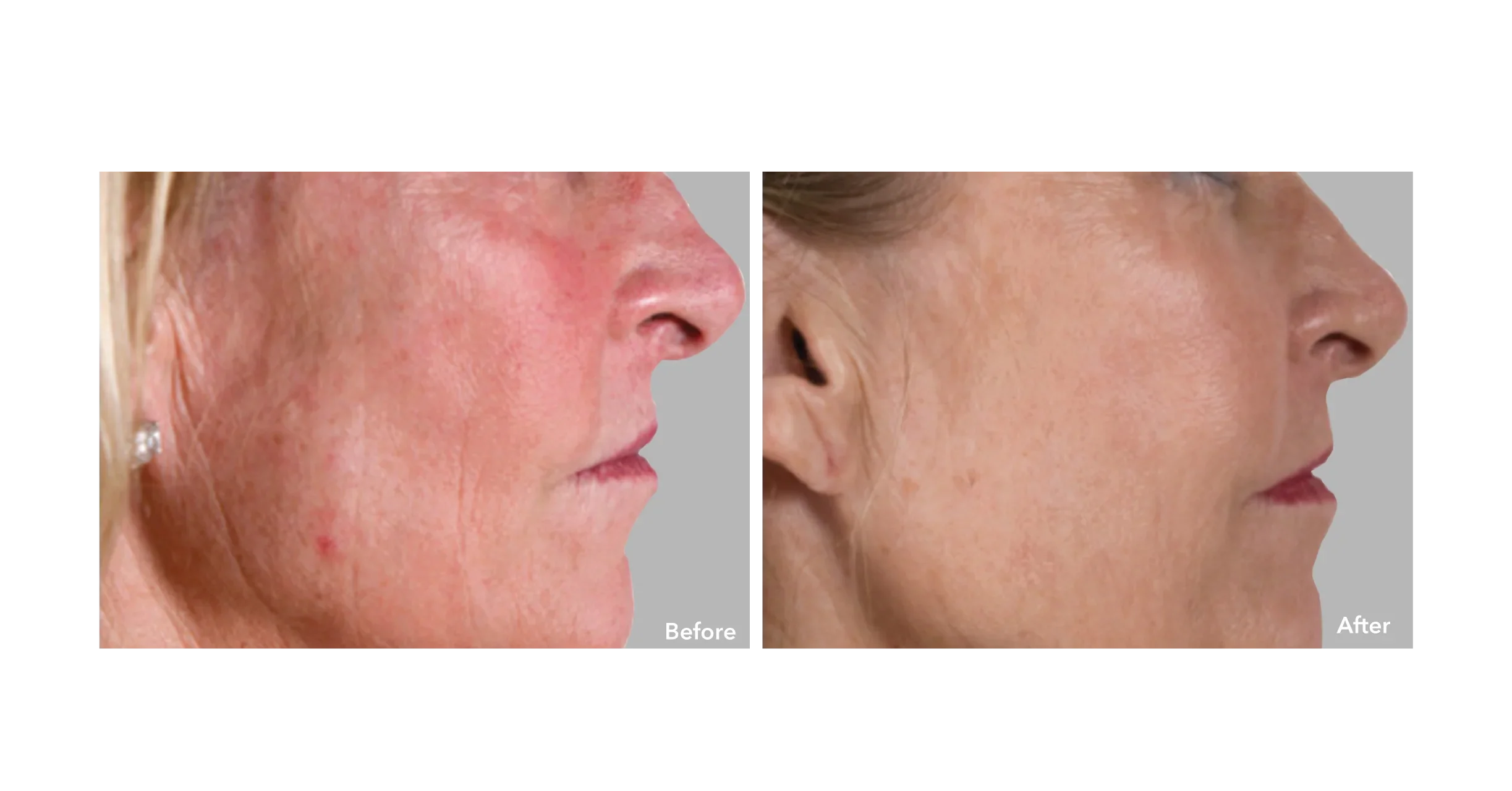 AnteAGE MD System