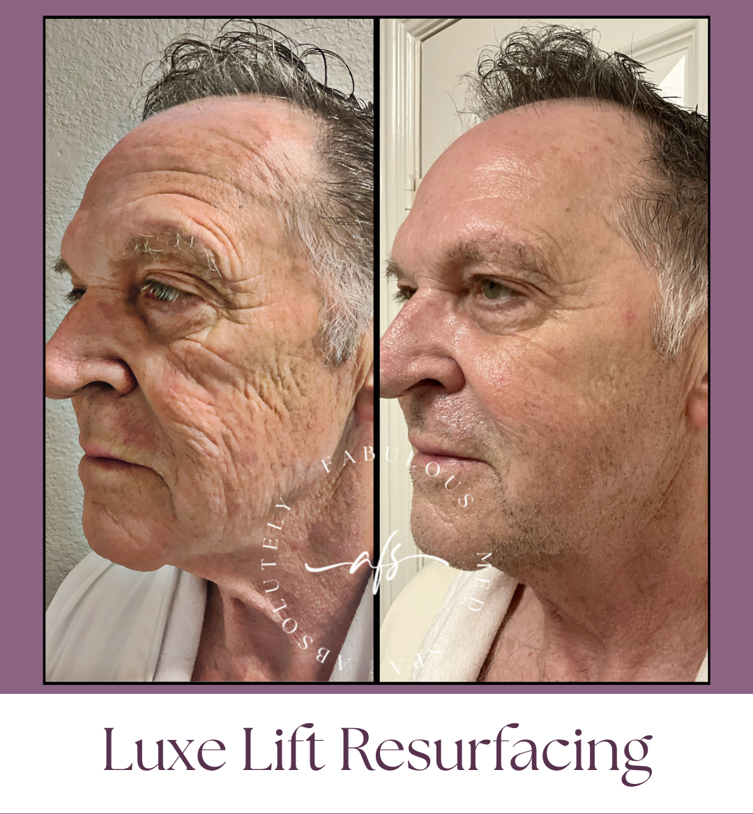 Laser Season in Frisco, Texas: Why Pre-Treating Your Skin with Alastin Restorative Skin Complex is Essential